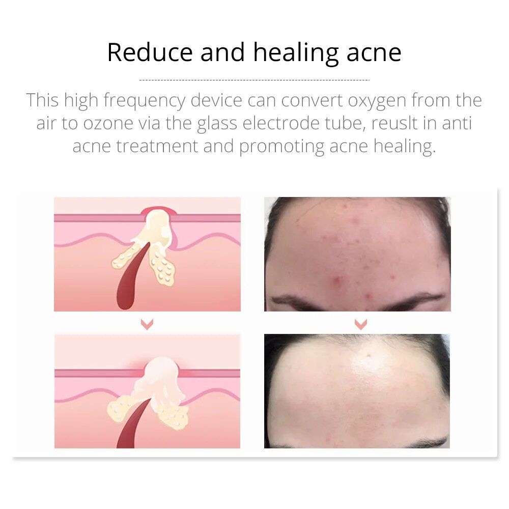 portable high frequency facial therapy wand